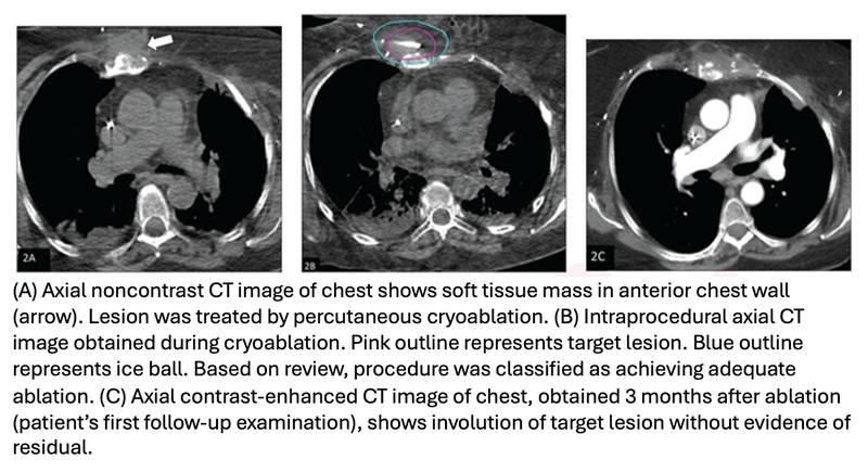 Cryoablation Effective, Safe for Metastatic Soft-Tissue Sarcoma in Adults