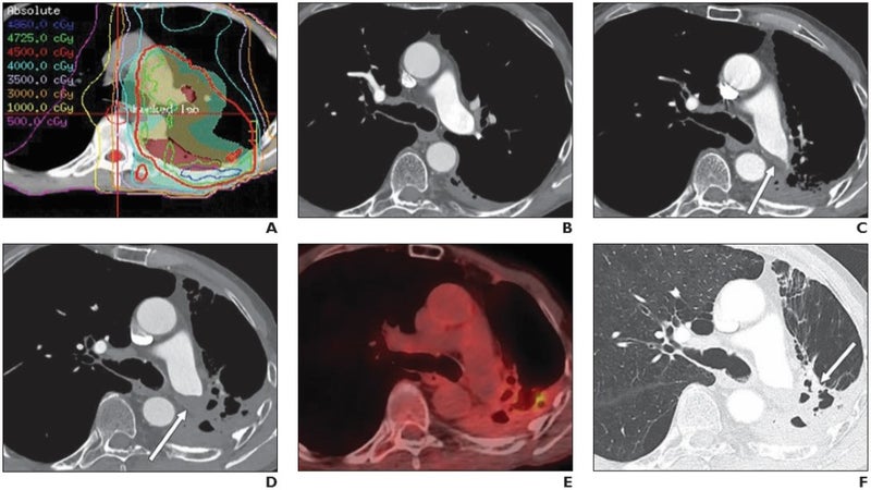 Penn Medicine Nabs $9M Grant to Advance Technology That Lights up Lung Tumors