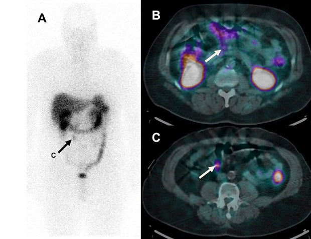 PET/CT radiopharmaceutical agent 68Ga-Dotatate better identifies neuroendocrine tumors