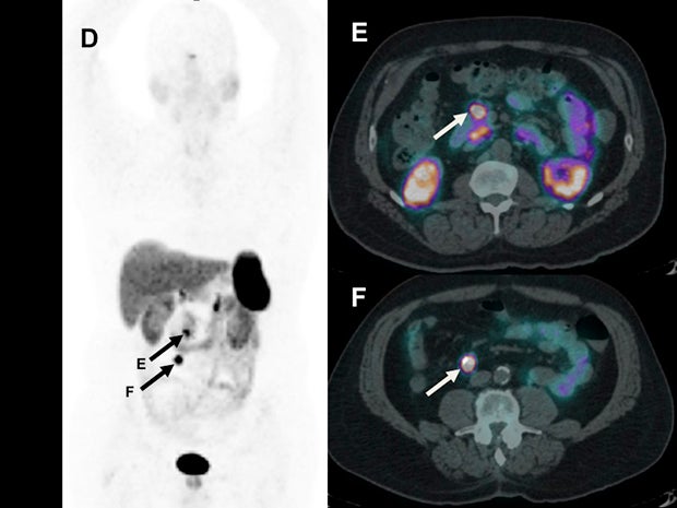 PET/CT radiopharmaceutical agent 68Ga-Dotatate better identifies neuroendocrine tumors