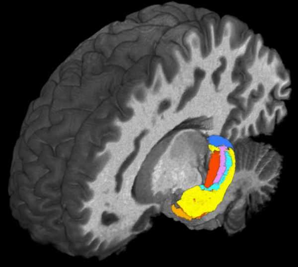 Subtle Differences Detected in Structure and Function of Hippocampus with 7T MRI in Down Syndrome Patients