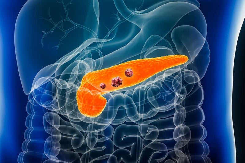 Adding Metastasis-Directed Radiation Therapy Improves Progression-Free Survival in Oligometastatic Pancreatic Cancer