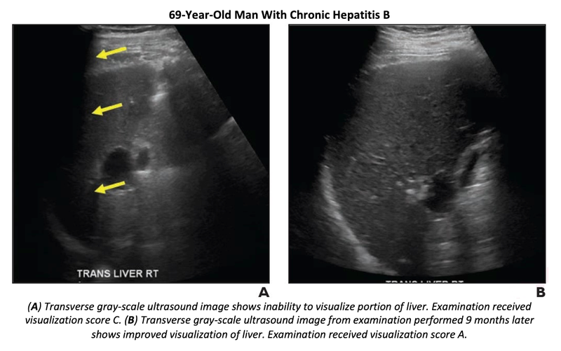 Ultrasound LI-RADS Study Suggests a Single VIS C Exam Does Not Warrant Change of Surveillance strategy
