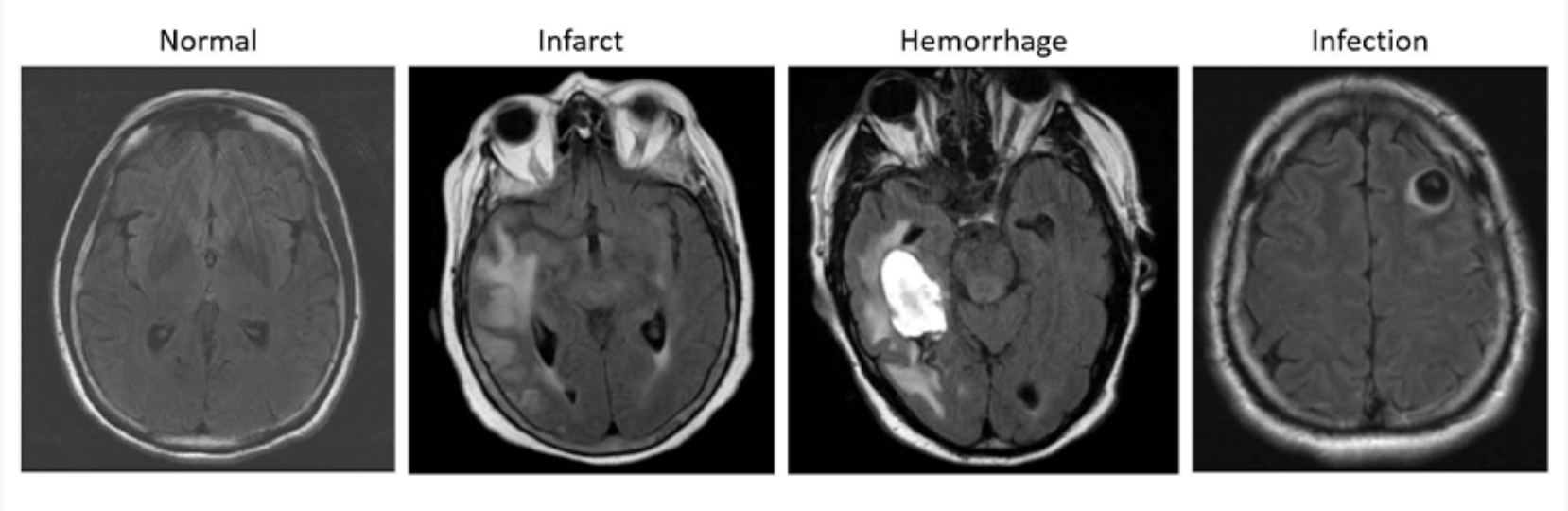 AI-based System Could Help Triage Brain MRIs