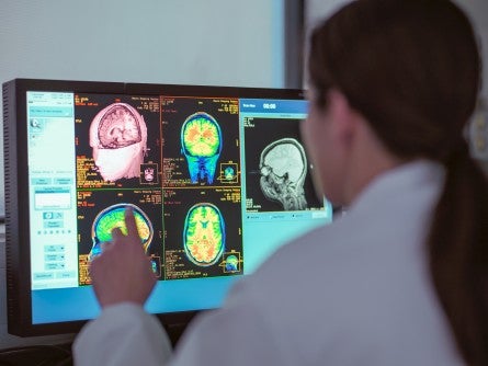 AI Technique for MRI May Guide Real-Time Glioblastoma Treatment
