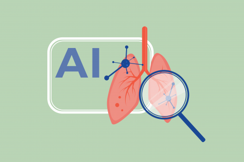 AI Helps With Immunotherapy Treatment Planning in Patients With Advanced Lung Cancer