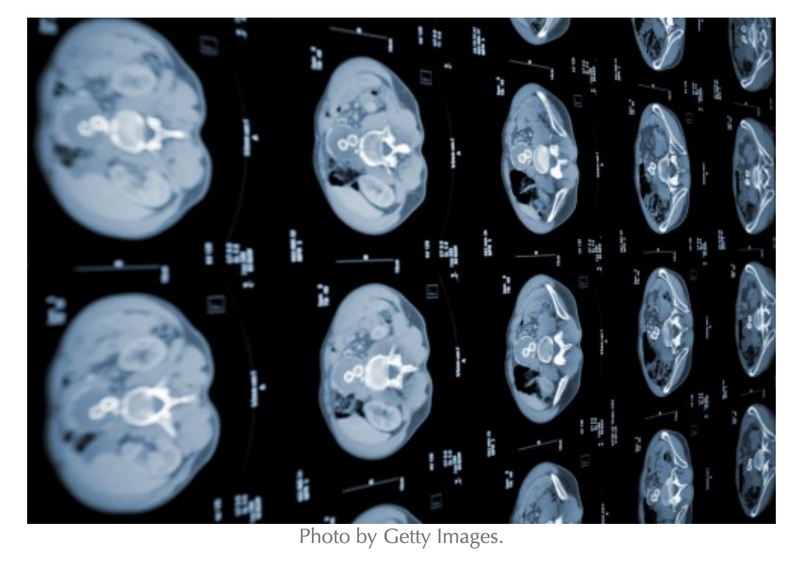 RSNA Margulis Award Honors AI Tool for Pancreatic Cancer Detection