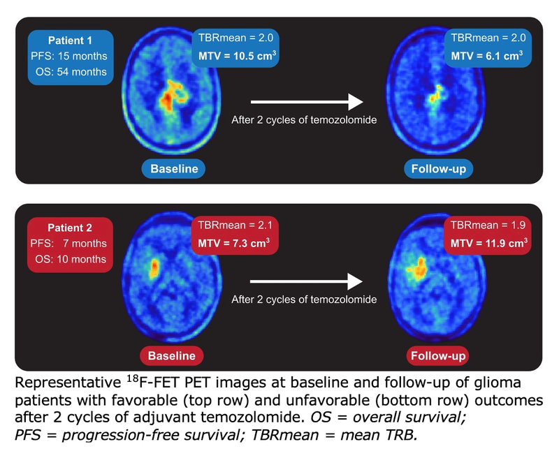 AI Tool for PET Imaging Provides Automated Evaluation of Brain Tumors