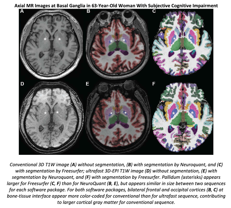 Ultrafast 3D T1W Compares to Conventional 3D T1W yet Shows Bias in Volume Measurements