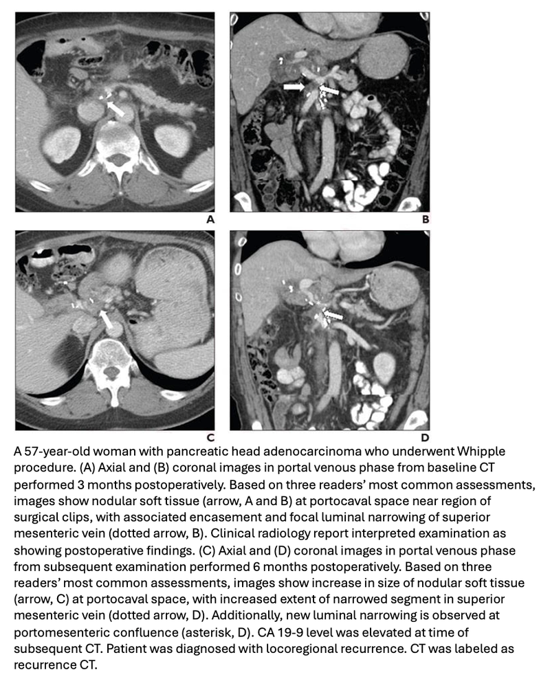 New Soft Tissue on CT Suggests Local Recurrence After Pancreatic Cancer Resection
