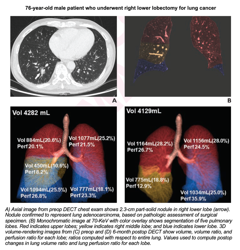 Dual-Energy CT Provides Insight on Physiologic Changes After Lung Cancer Surgery