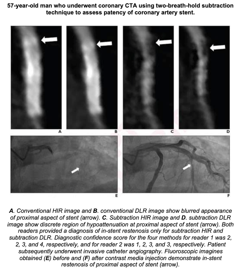 Deep Learning With Subtraction Technique Ideal for Evaluating Stents with CTA