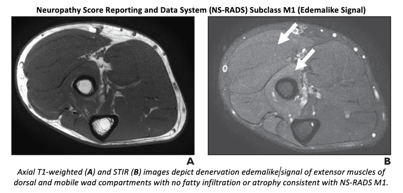 Study Validates MR Neuropathy Score Reporting and Data System