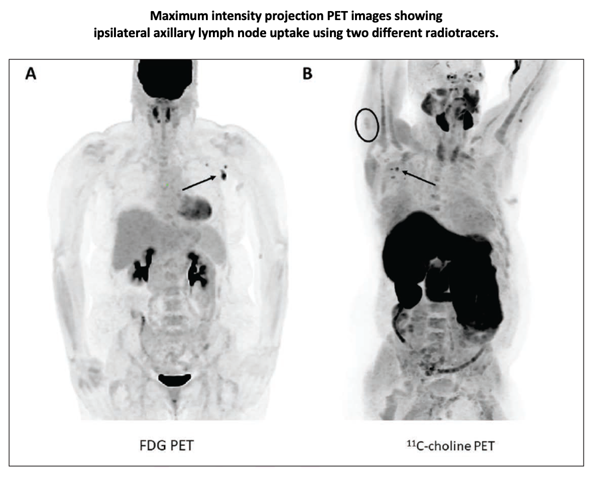 Study Finds Abnormal Radiotracer Uptake on PET After COVID Vaccination
