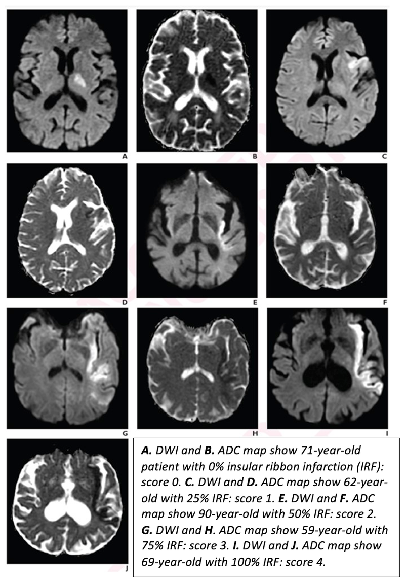 Percent Insular Ribbon Infarction Predicts Infarct Growth Rate, Stroke Outcome