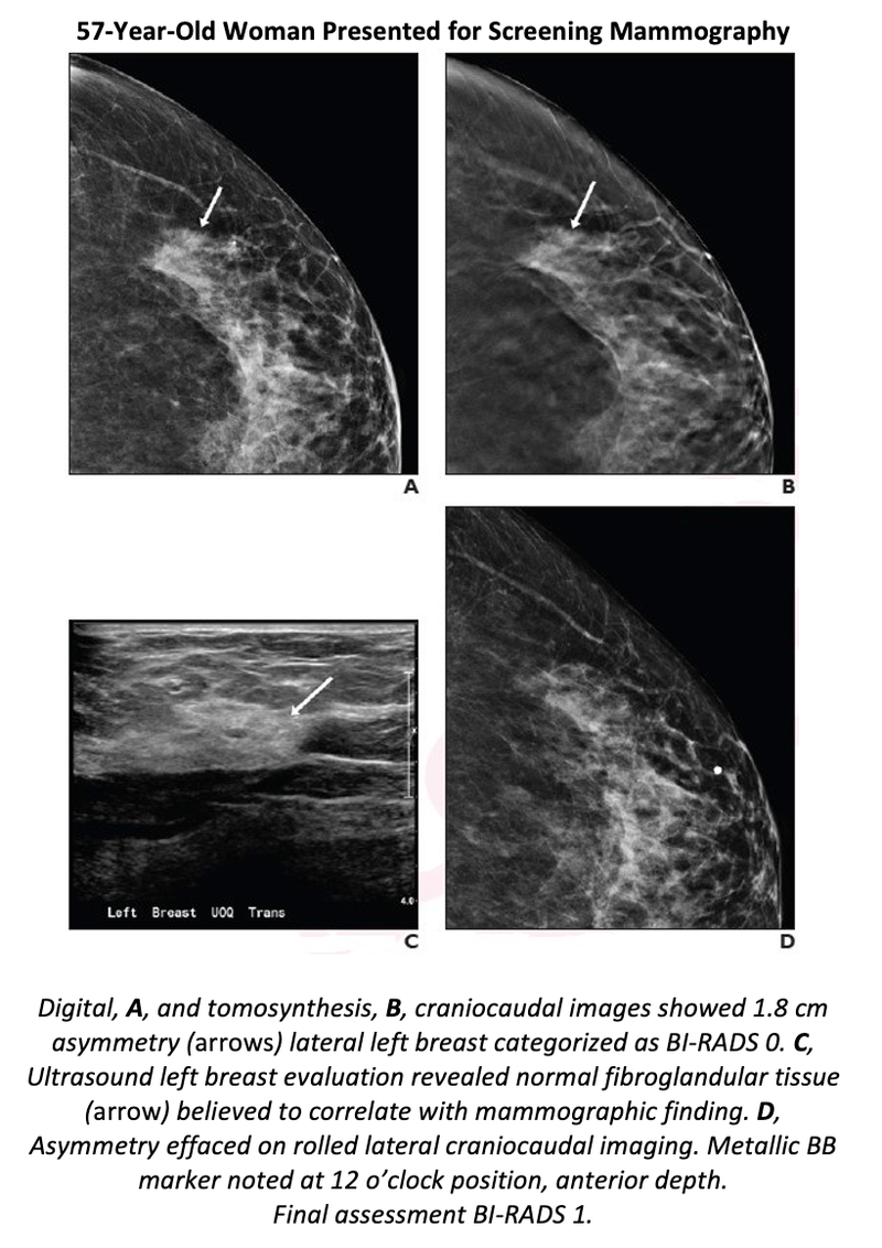 Study Recommends Use of Ultrasound First for DBT-recalled Noncalcified Masses