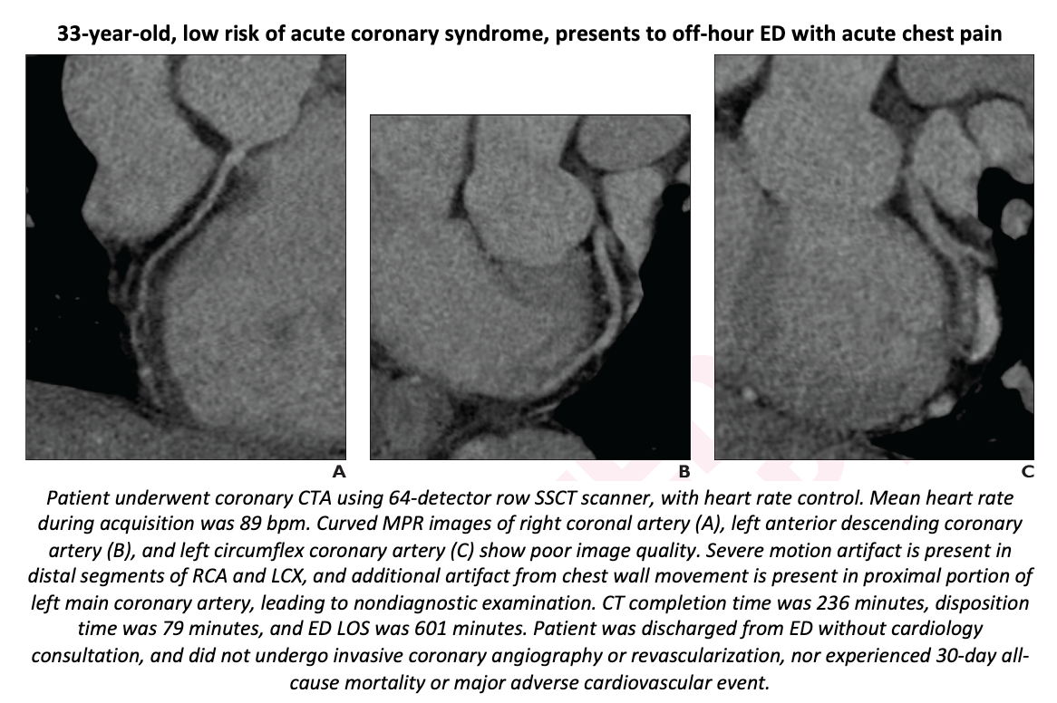 Dual-Source CT for Chest Pain Can Eliminate Use of Beta Blockers, Decrease Nondiagnostic Exams
