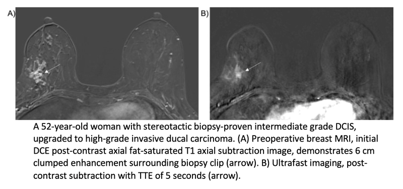Preoperative Ultrafast MRI May Predict DCIS Upgrade to Invasive Cancer