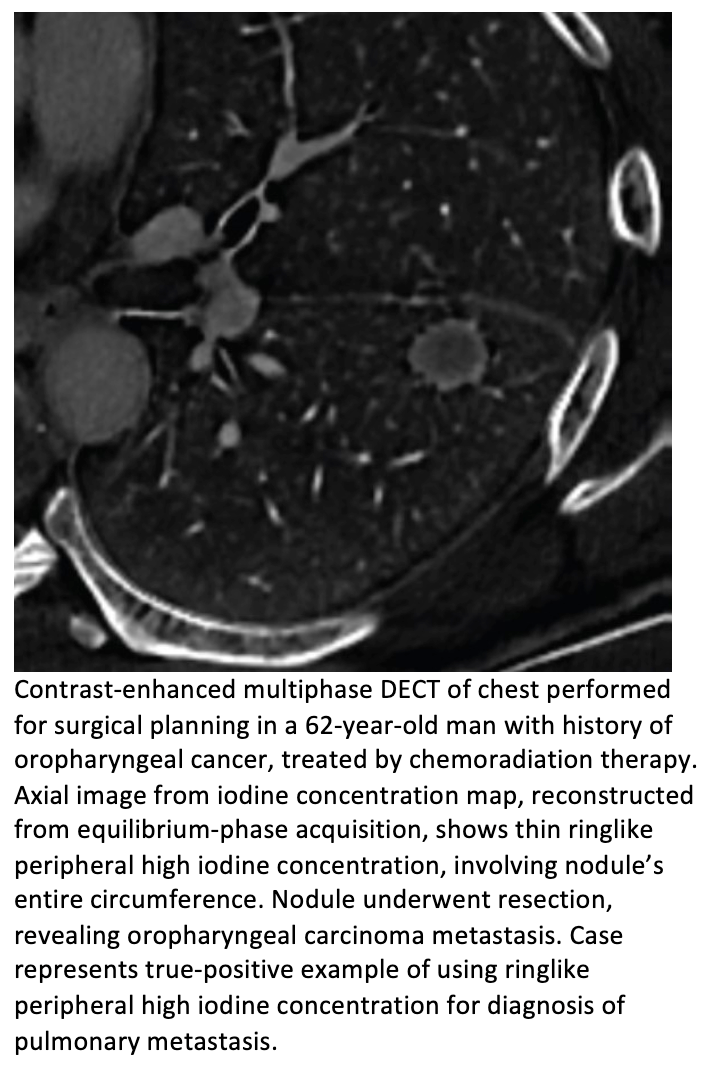 Dual-Energy CT Iodine Maps Differentiate Lung Cancer from Pulmonary Metastases