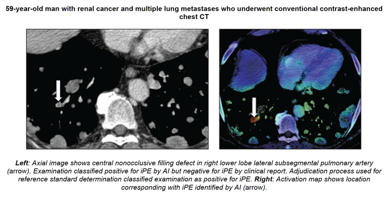 AI Tool Detects Incidental Pulmonary Embolus on Chest CT
