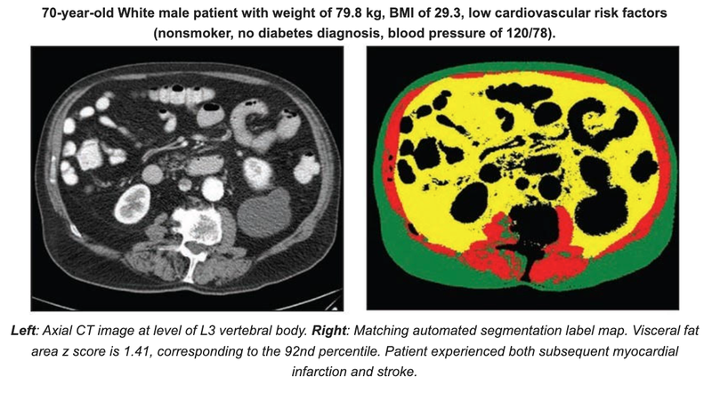Analysis of Body Composition Using Abdominal CT Augments Cardiovascular Risk Models