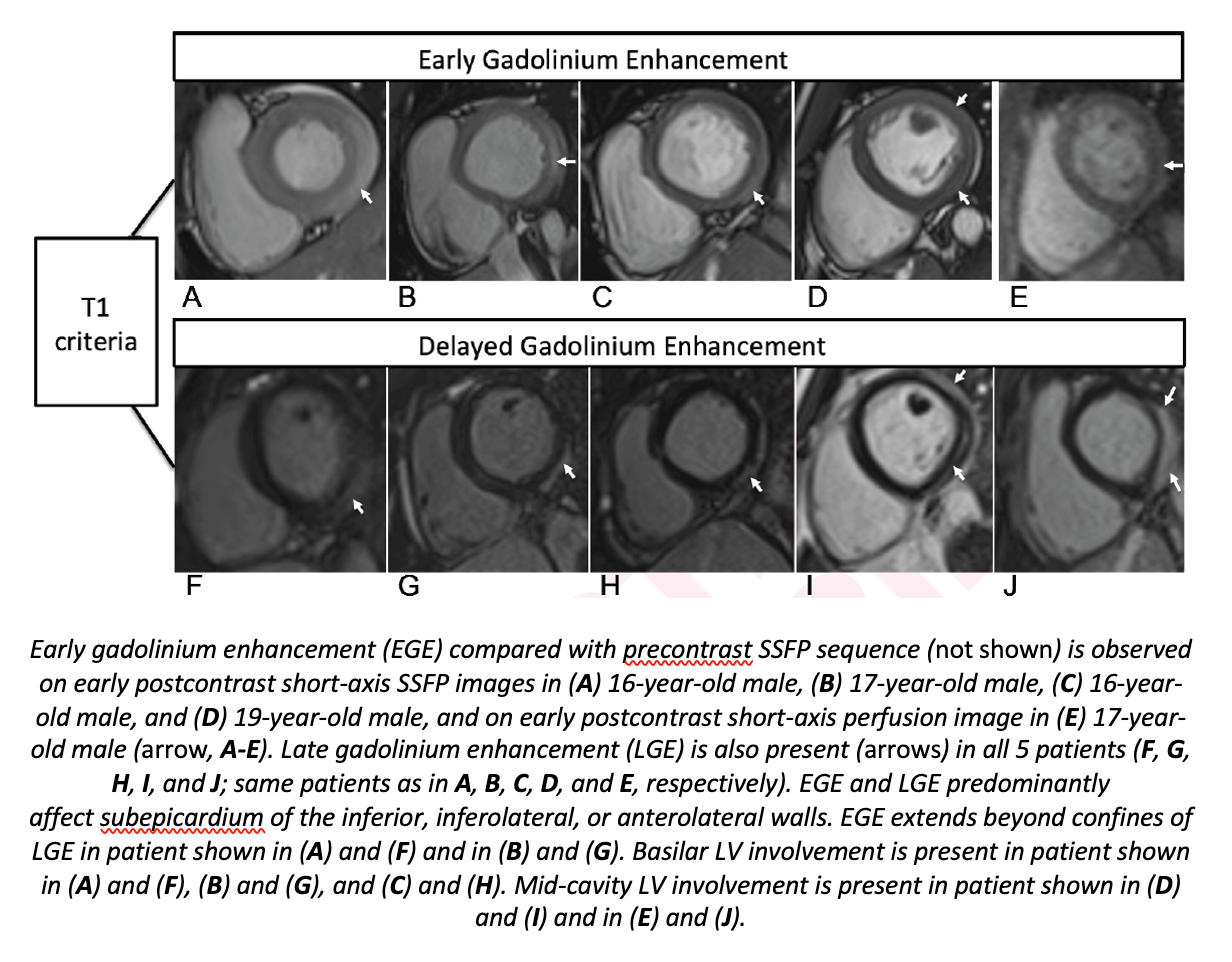 Cardiac MRI of Myocarditis in Adolescents after COVID-19 Vaccine