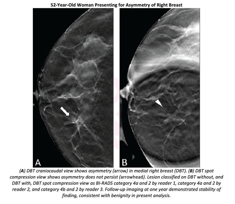 DBT Spot Compression View Clarifies Equivocal Findings