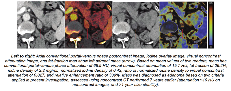 Dual-Energy CT Helpful in Characterizing Adrenal Adenomas