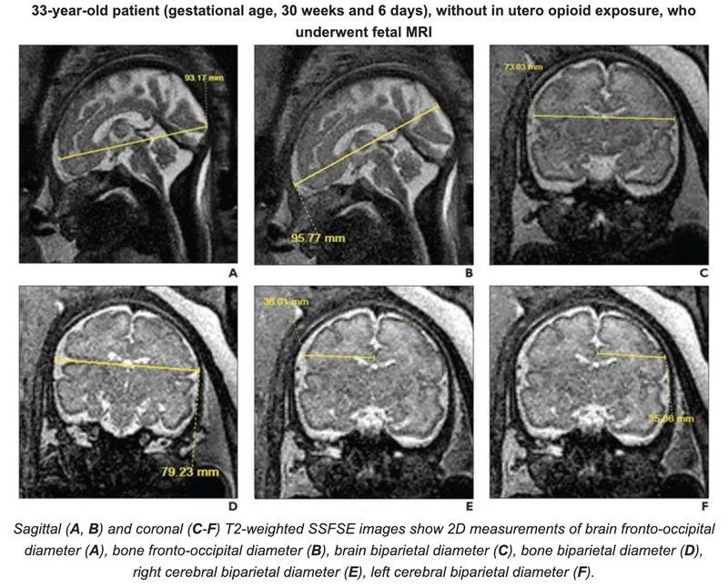 MRI Finds Smaller Brains in Opioid-Exposed Fetuses