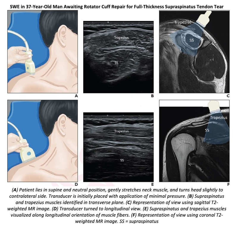 Shear Wave Elastography Helps Predict Rotator Cuff Repair