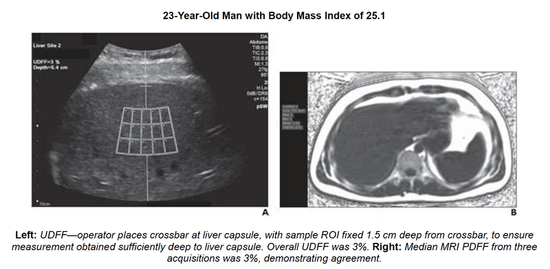 Ultrasound-Derived Fat Fraction for Hepatic Steatosis