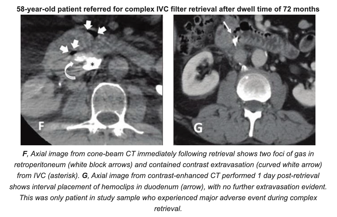 High Success and Low Adverse Rates With Specialized Referral Centers for Vena Cava Filter Retrievals