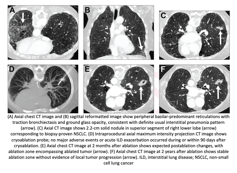 Ablation is Safe and Effective for Stage I-II Non-Small Cell Lung Cancer With Interstitial Lung Disease
