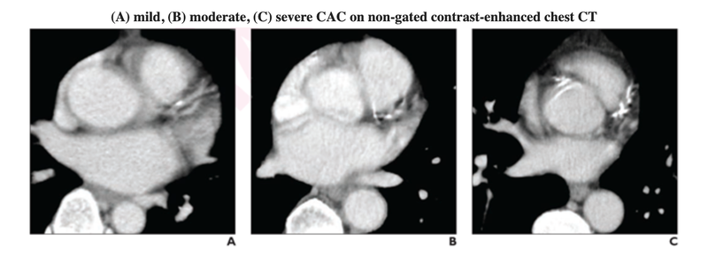 Visual Ordinal CAC Scoring on Chest CT Could ID Patients for Preventive Treatment