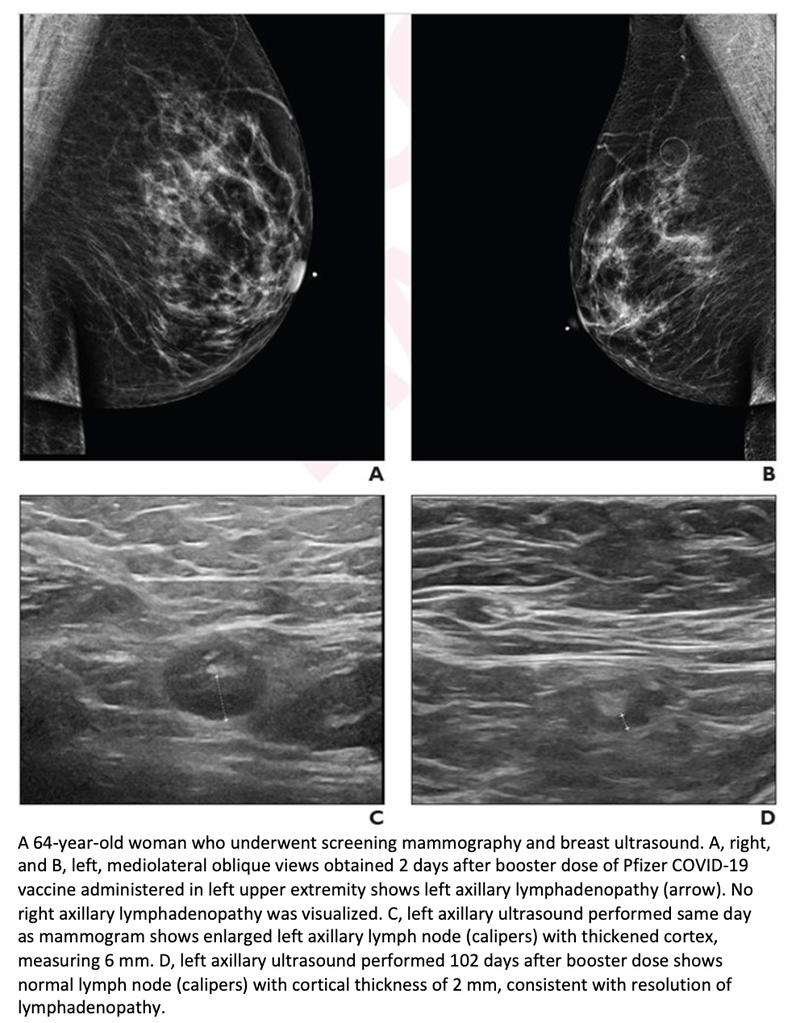 Axillary Lymphadenopathy After Covid Booster Resolves in Approximately 102 Days