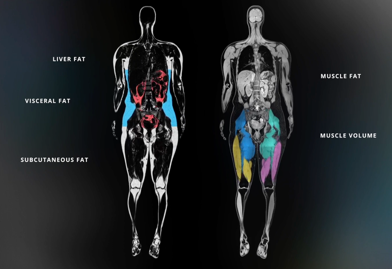 Body Composition Profile Using MR Images Nets US and Canada Regulatory Clearances