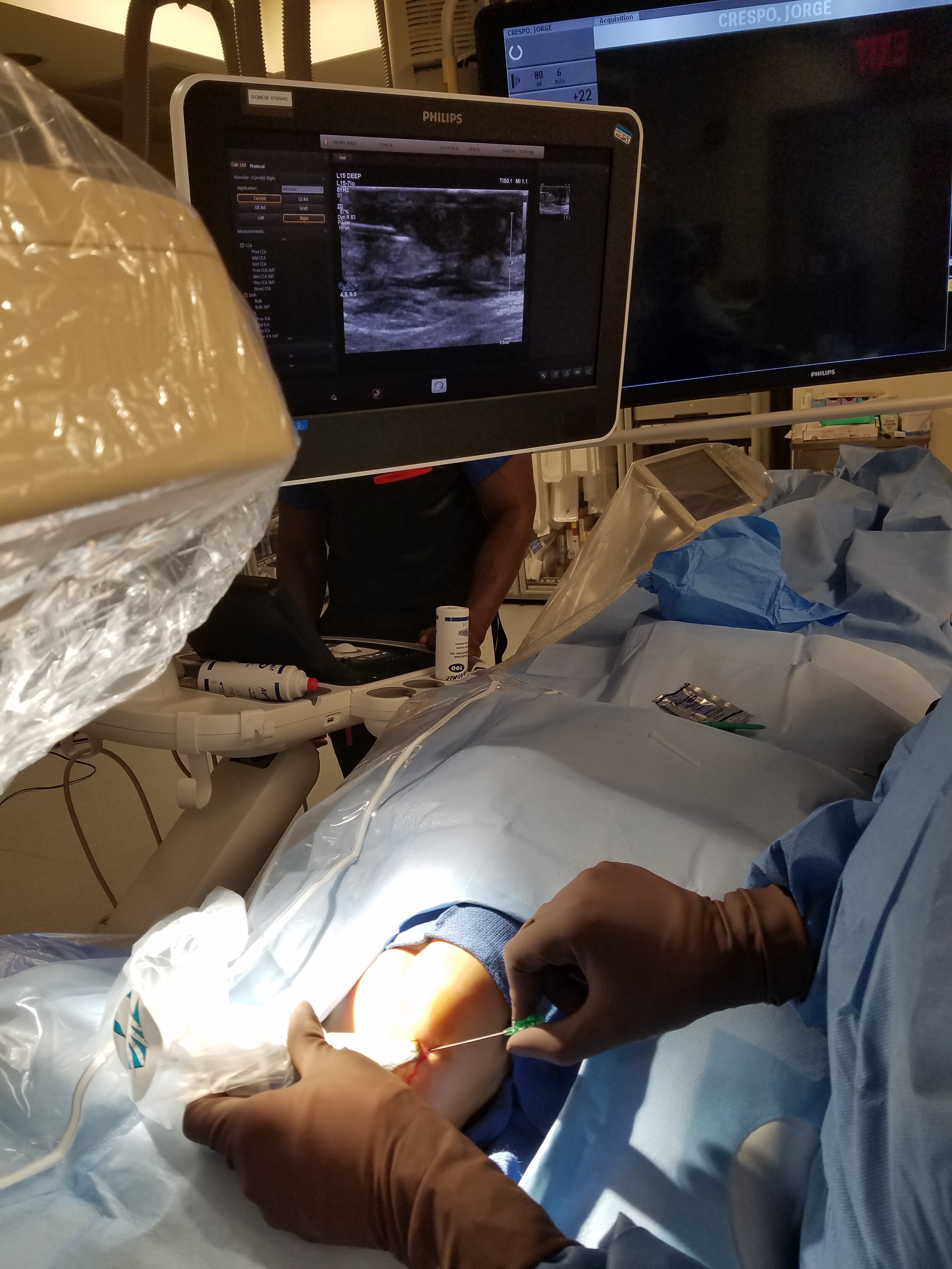 Jugular vein single-stick tunneled central venous access feasible for neonates