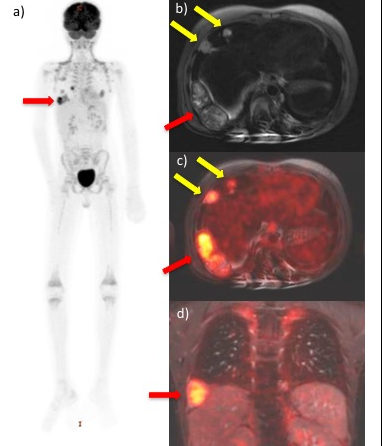 How to perform whole-body PET/MRI on pediatric patients