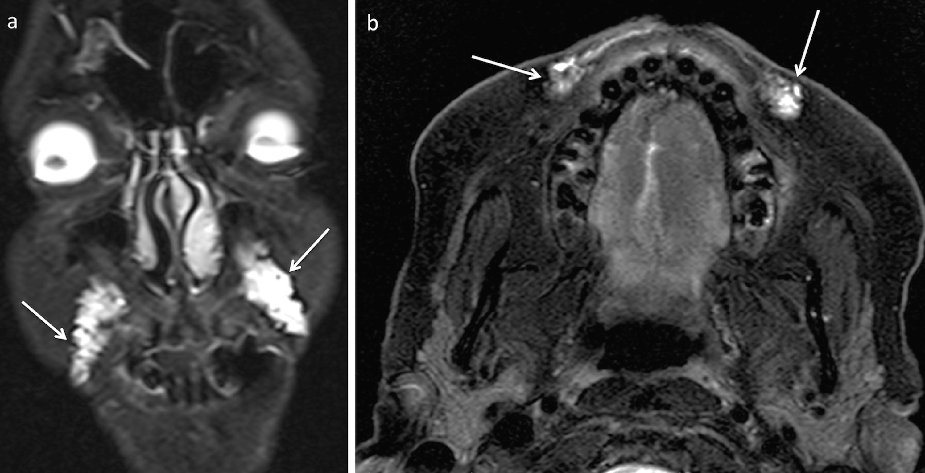 What radiologists need to know about injectable facial fillers
