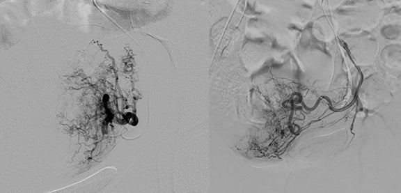 Reducing fluoroscopy radiation dose during UFE procedures