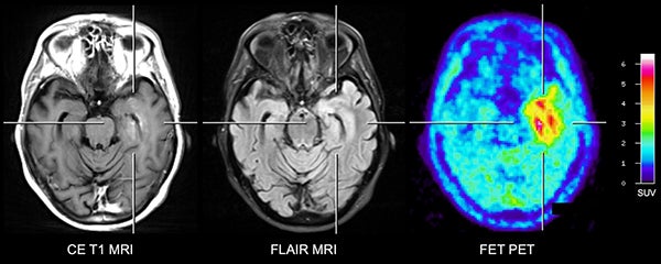 MRI plus FET PET recommended for new glioblastoma cases