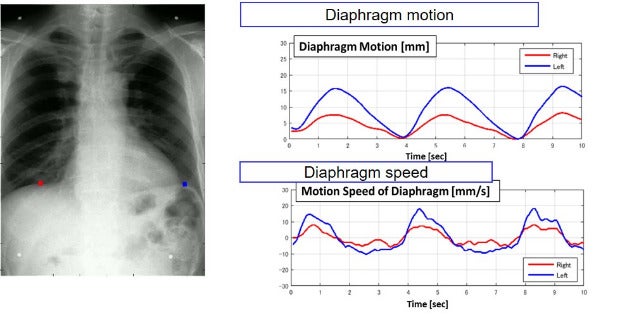Konica Minolta Healthcare America receives FDA clearance for Dynamic Digital Radiography