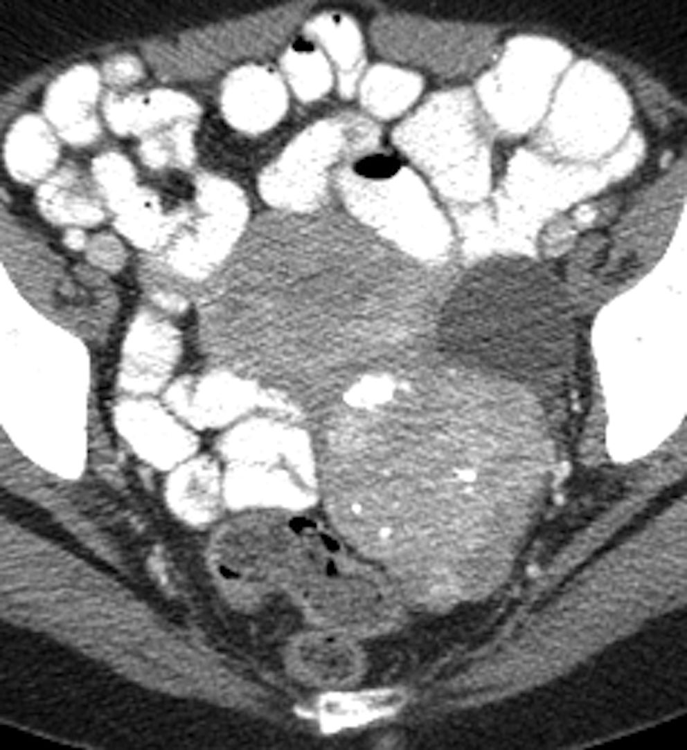 CT aids adnexal lesion management of postmenopausal cancer survivors