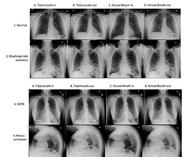 2019 ATS: Dynamic digital radiology technology enhances dyspnea diagnoses