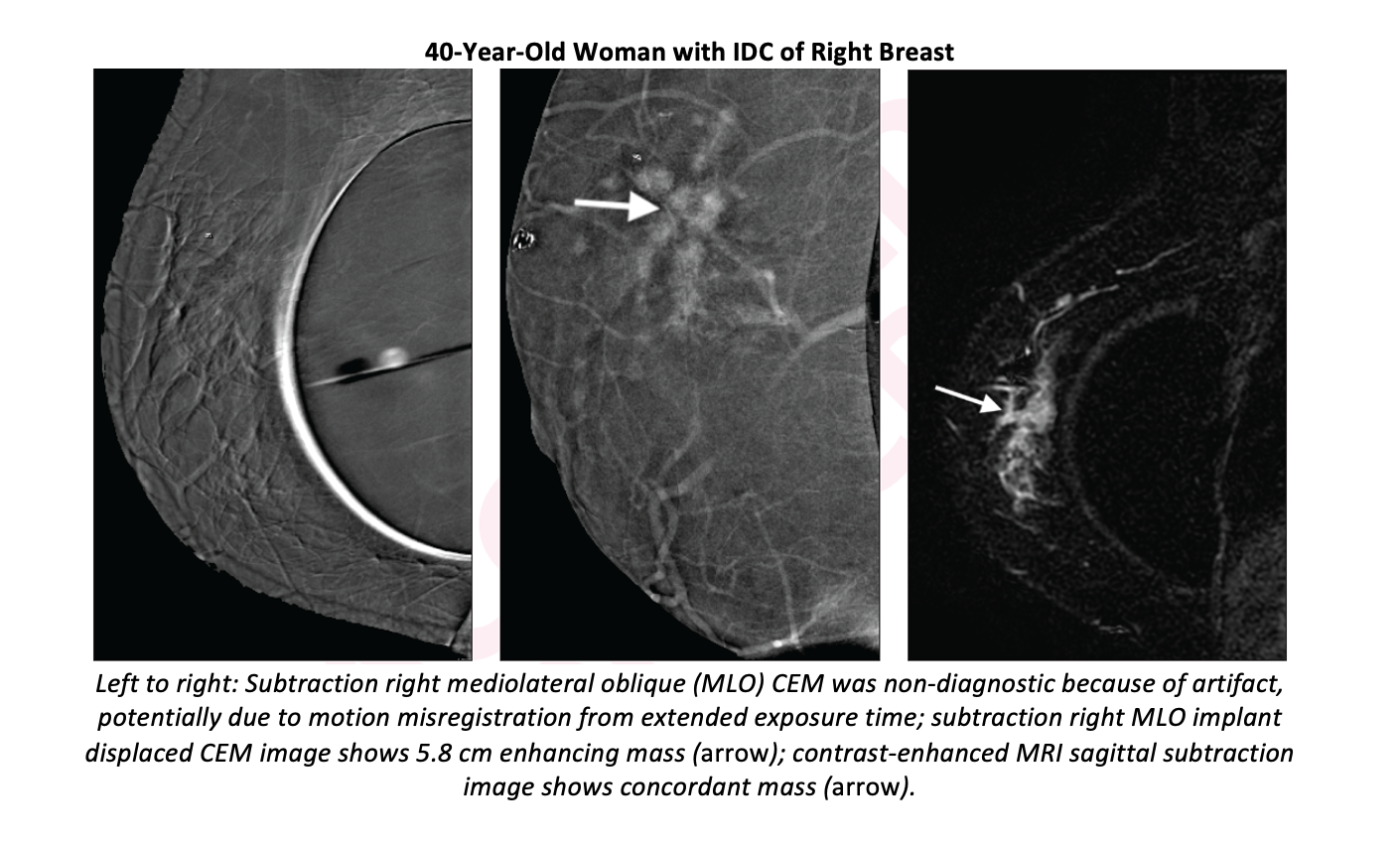 Contrast-enhanced Mammography may Help Stage Cancer in Women with Breast Augmentation