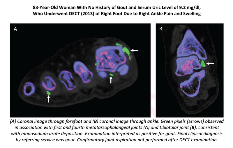 Adopting Dual-energy CT Leads to Lower Equivocal Interpretations in Gout