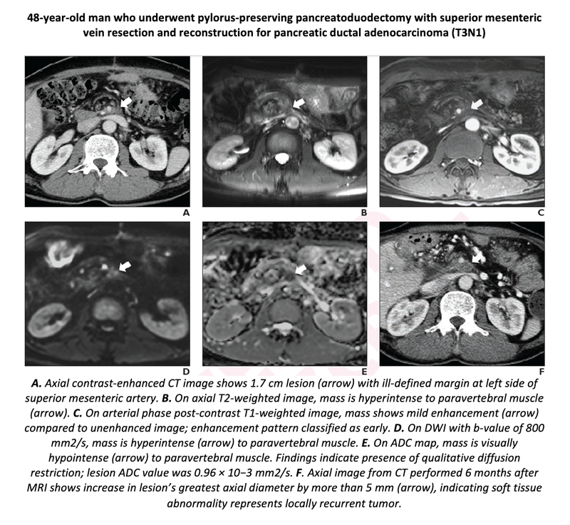 Adding DWI Improves Differentiation of Locally Recurrent Pancreatic Cancer