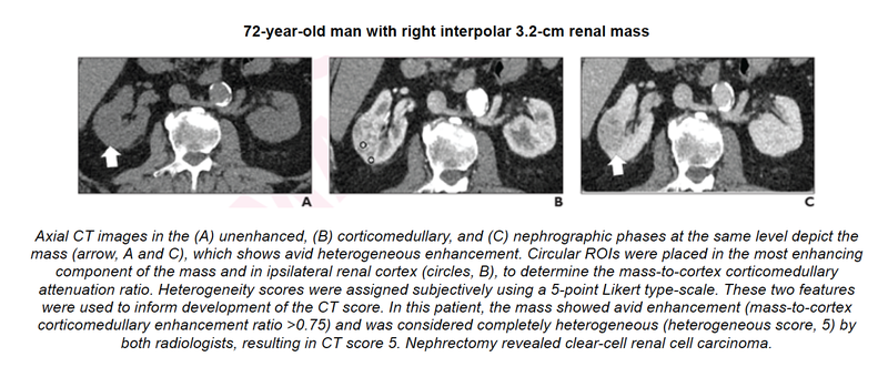 Five-Tiered CT Algorithm for Diagnosing Clear-Cell Renal Cell Carcinoma