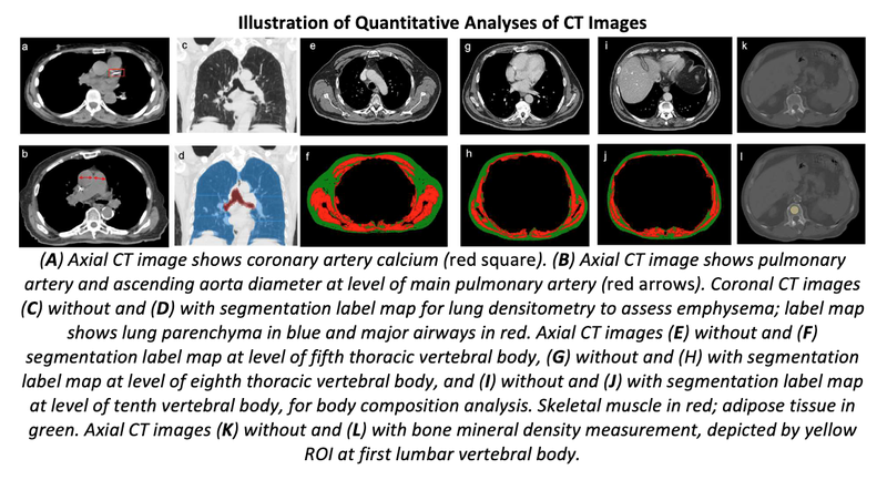 Noncancerous Chest CT Performed Before Stage 1 Lung SBRT Predicts Survival
