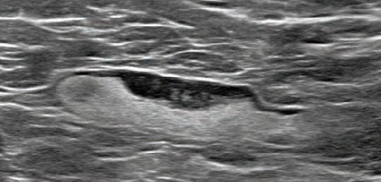 Axillary Adenopathy after COVID-19 Vaccination Detected in Breast Imaging